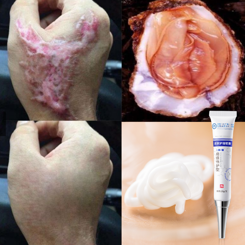 【Green touch】Scar Removal Cream 20g Skin Repair Acne Scar Spot Remover Acne Treatment Blackhead Whitening Cream Stretch Marks Acne Removal Treatment Cream